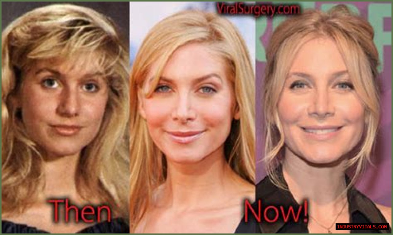 Elizabeth Mitchell Plastic Surgery Before and After